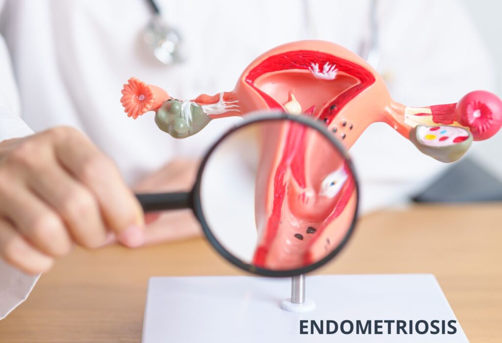 Endometriosis todo lo que necesitas saber
