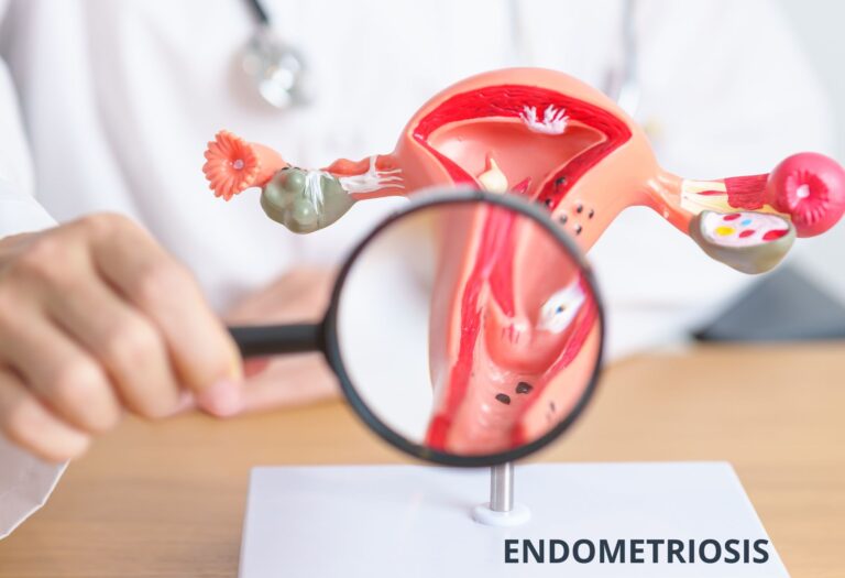 Endometriosis: todo lo que necesitas saber 2 Endometriosis todo lo que necesitas saber